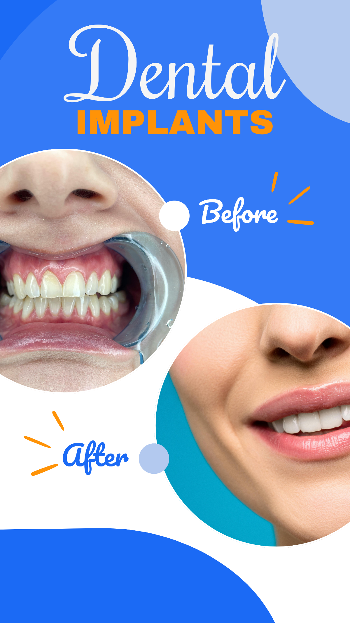 Dental Implants Before  After Post Template