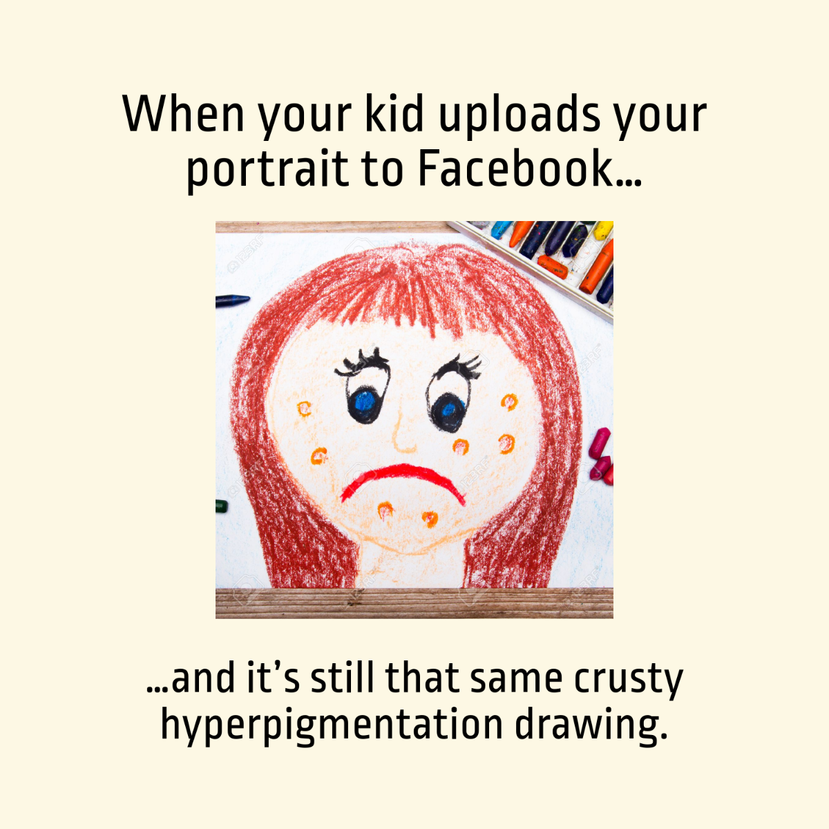 Free Hyperpigmentation Meme Template